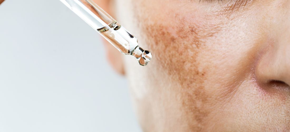 traitement tache de vieillesse