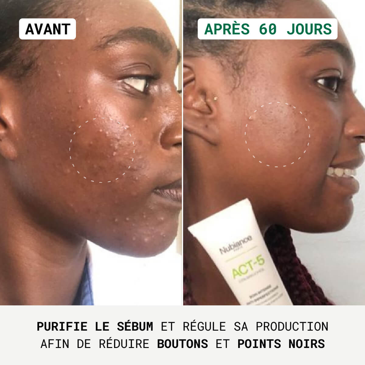 Act-5® - Anti-Imperfection Treatment