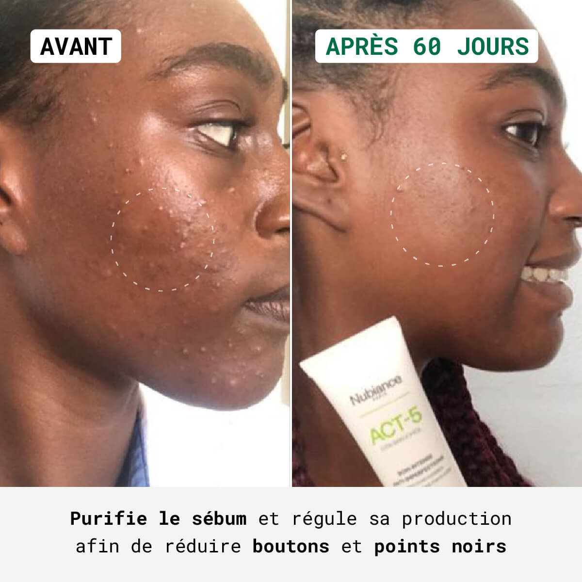 Act-5® - Soin Anti-Imperfections