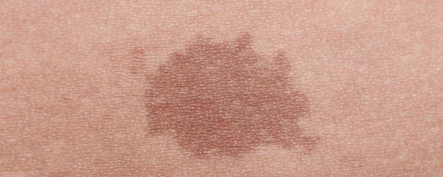 hyperpigmentation post-inflammatoire