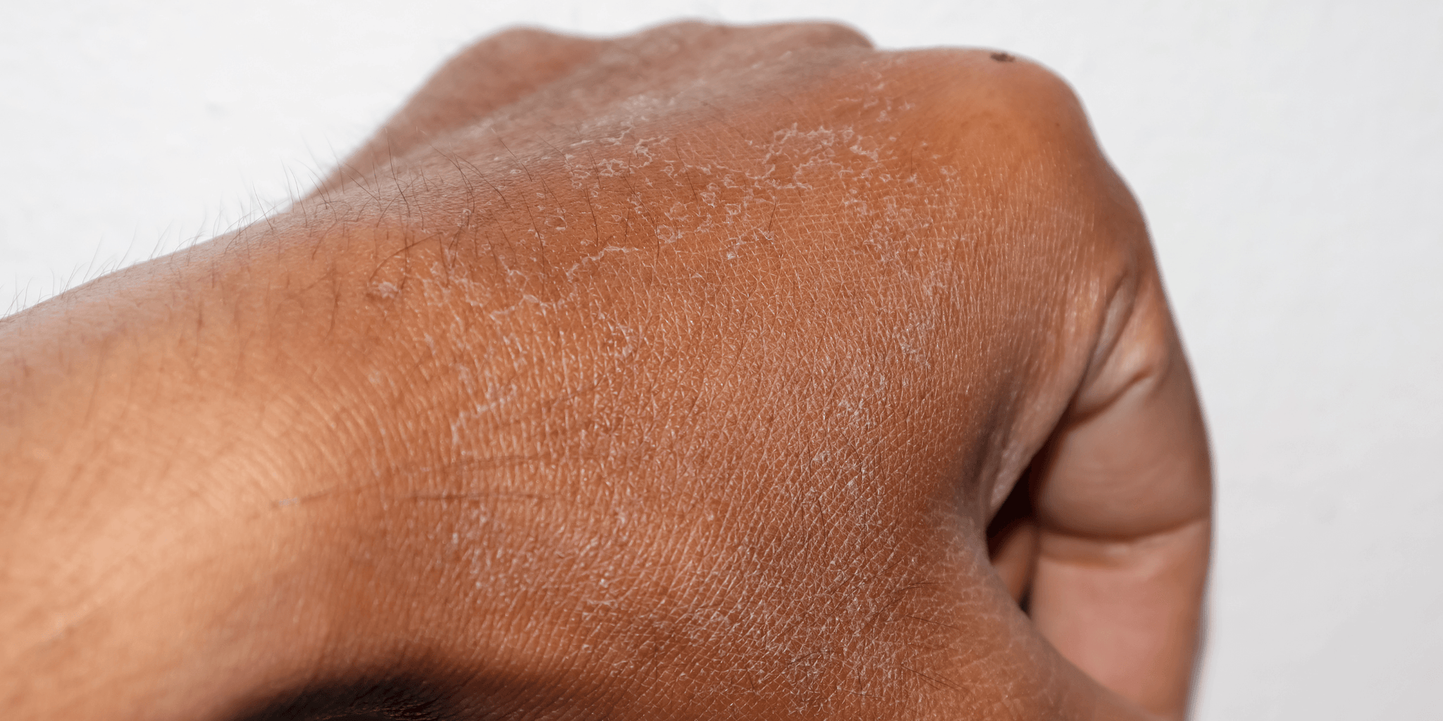 Desquamation de la peau : que faire ?