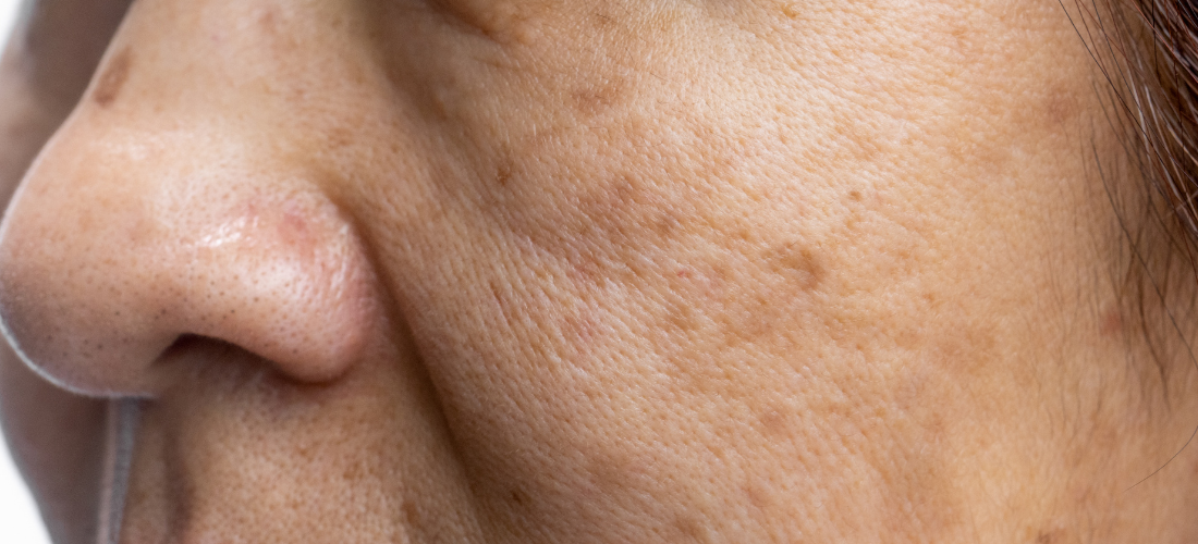 L’importance d’un soin anti-taches visage pour une peau irrésistible