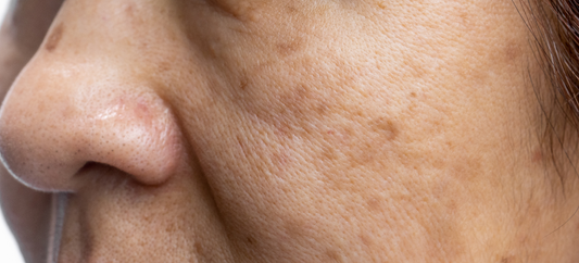 L’importance d’un soin anti-taches visage pour une peau irrésistible