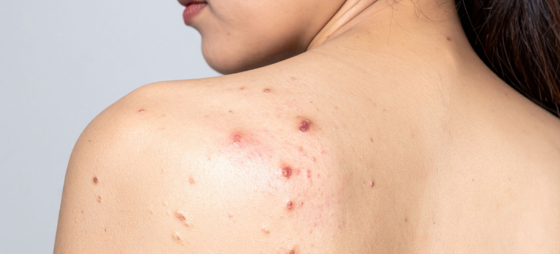 Boutons dans le dos : comment s’en débarrasser ?