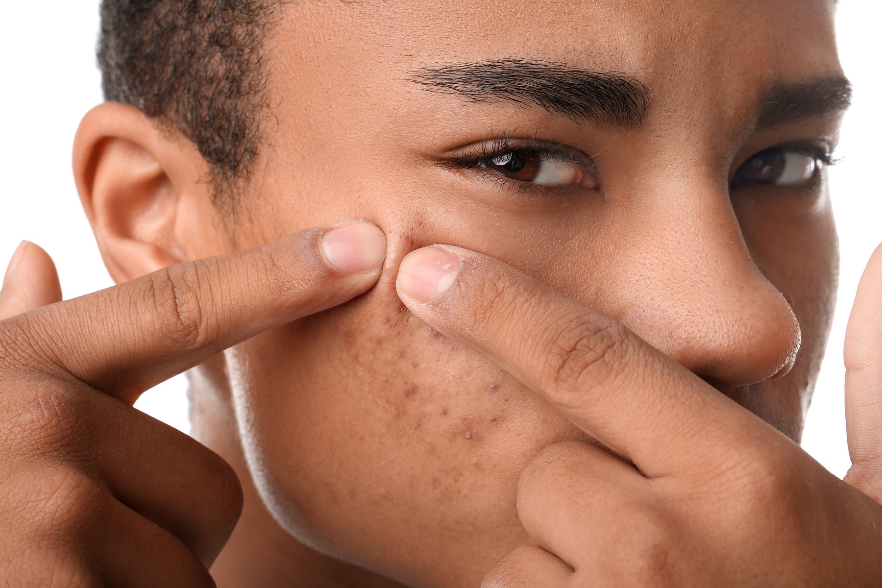 Les 3 types de cicatrices d'acné (et comment les traiter ? )