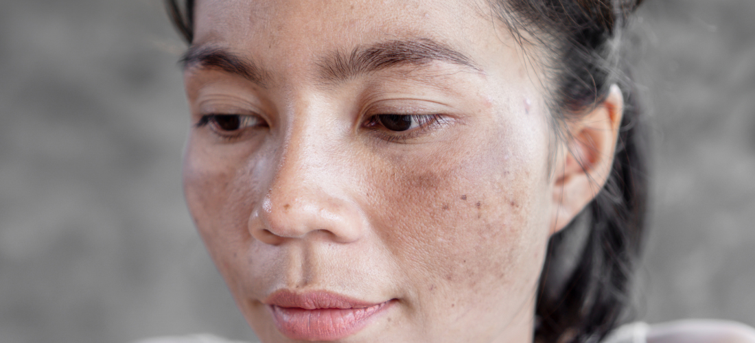 Taches pigmentaires sur le visage : prévention et traitement