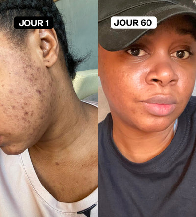 Two side-by-side images showing skin improvement over 60 days.